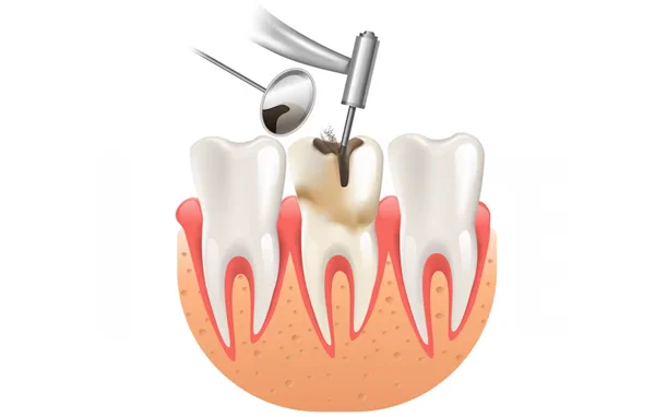 Advance Dental Filling